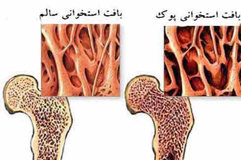 دانلود پاورپوینت استخوان و پوکی استخوان