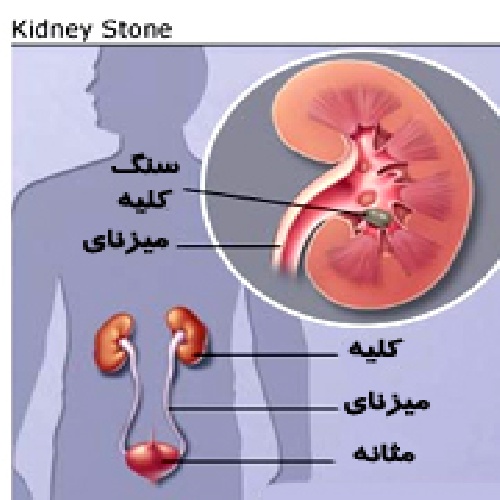 دانلود پایان نامه پزشکی سنگ های ادراری